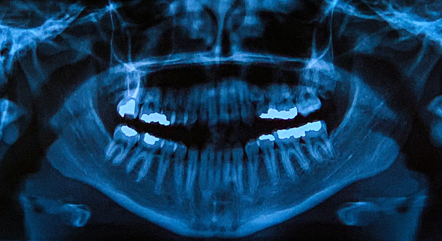 "NOVOCAINE" (2019)
